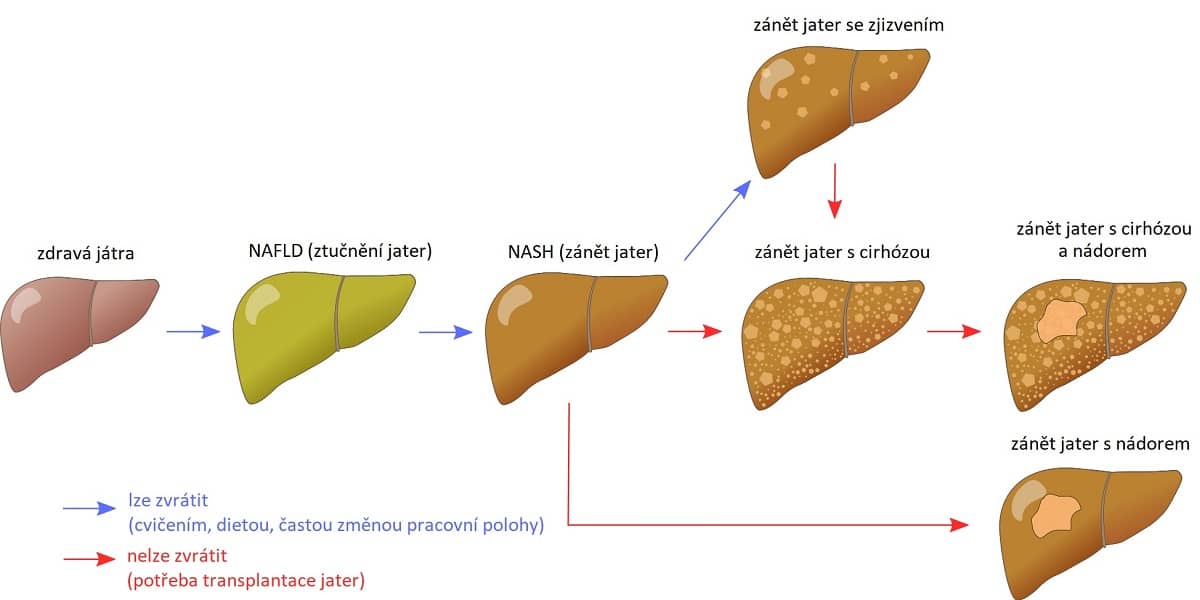 postup NAFLD